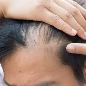 کمبود ویتامین و نازک شدن مو