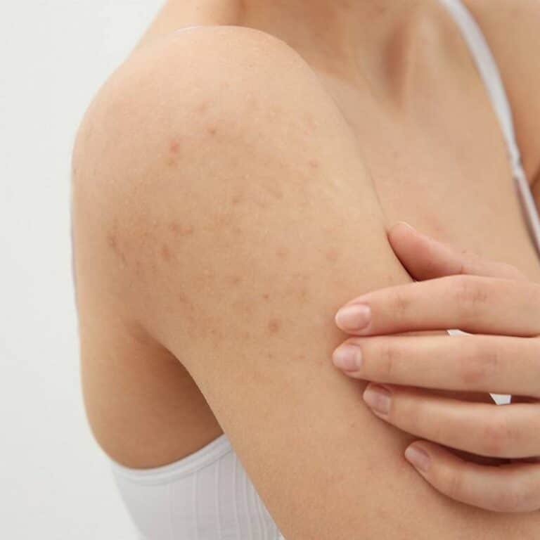 Photo of types of eczema ..