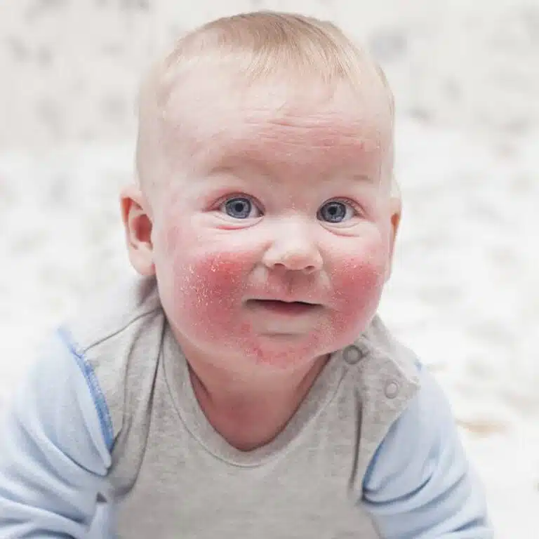 Photo of types of eczema ....
