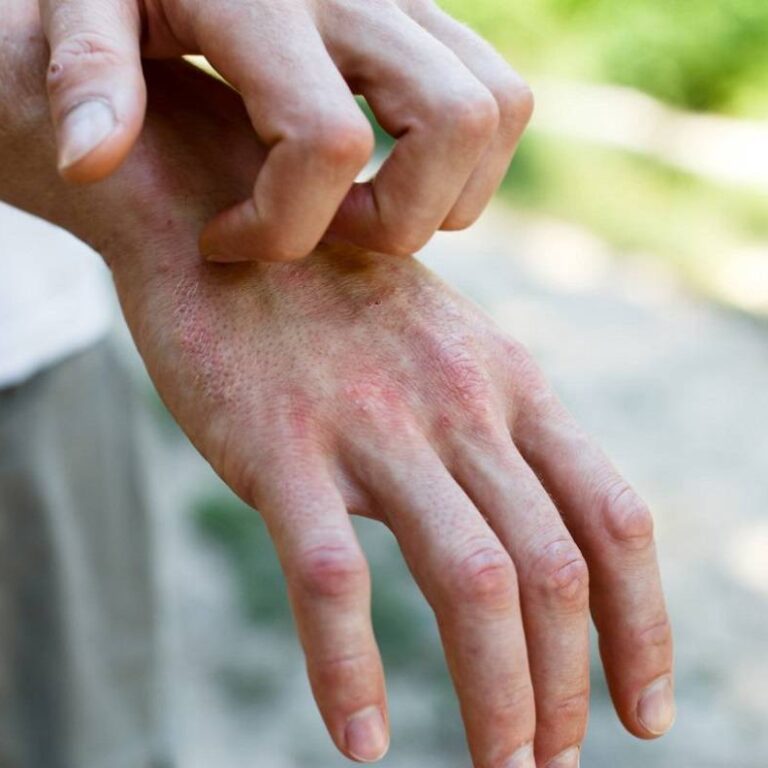 Photo of types of eczema .....