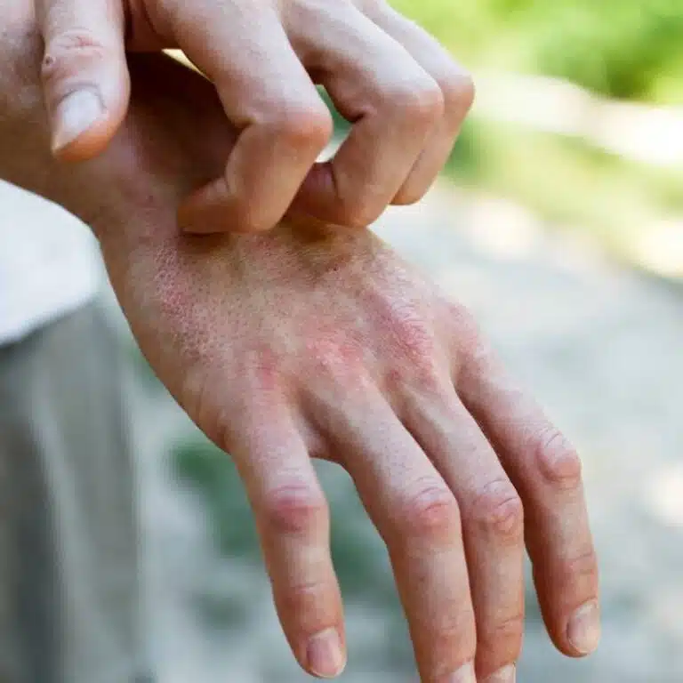 Photo of types of eczema .....