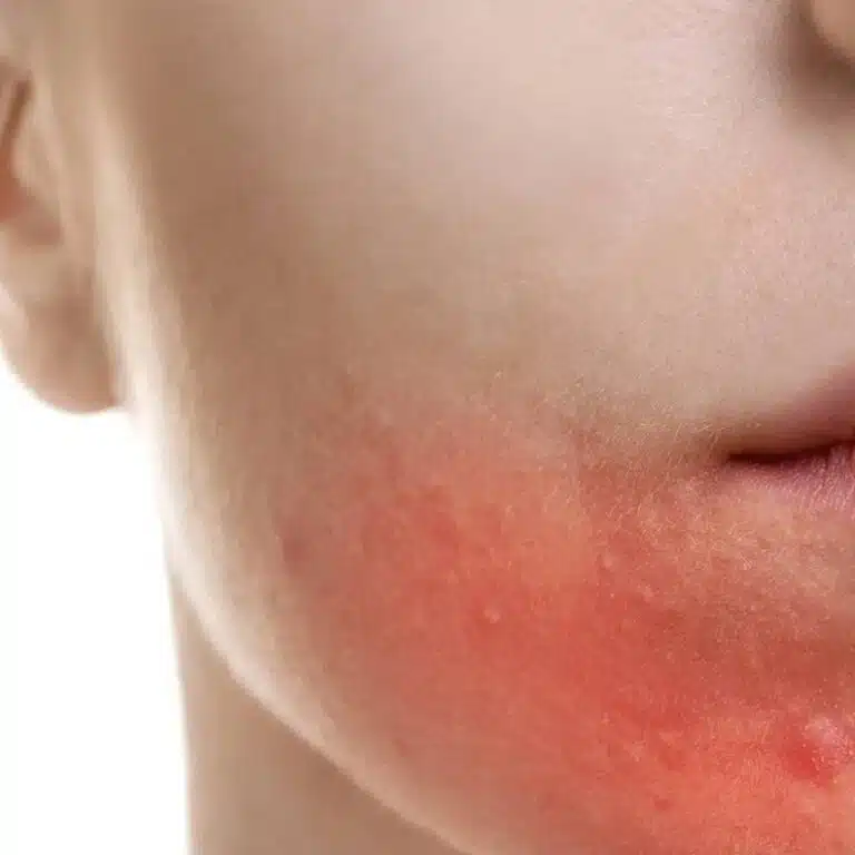 Photo of types of eczema