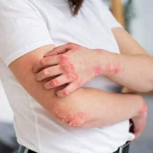چرا قارچ پوستی خوب نمیشود؟