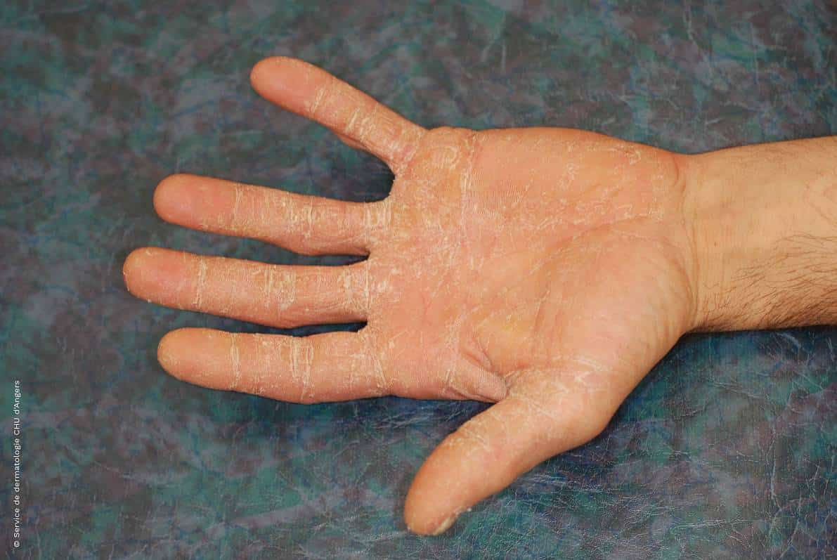 hand skin fungus ..