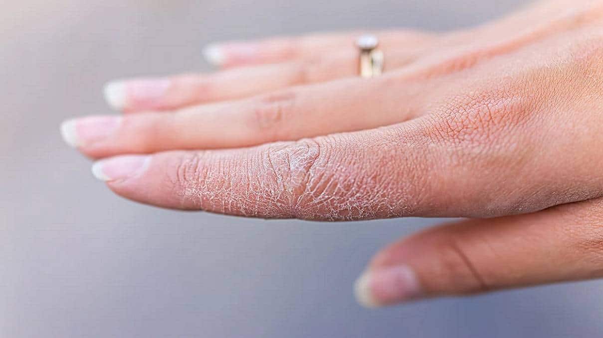 hand skin fungus .