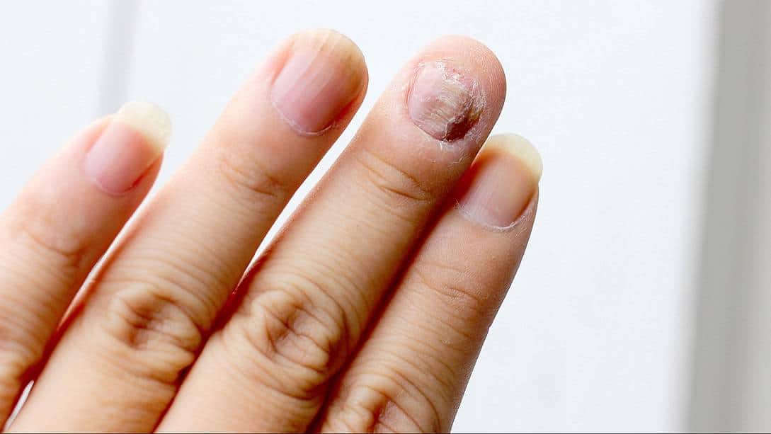 hand skin fungus ...