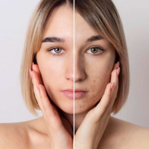 چگونه سوراخ های صورت را از بین ببریم