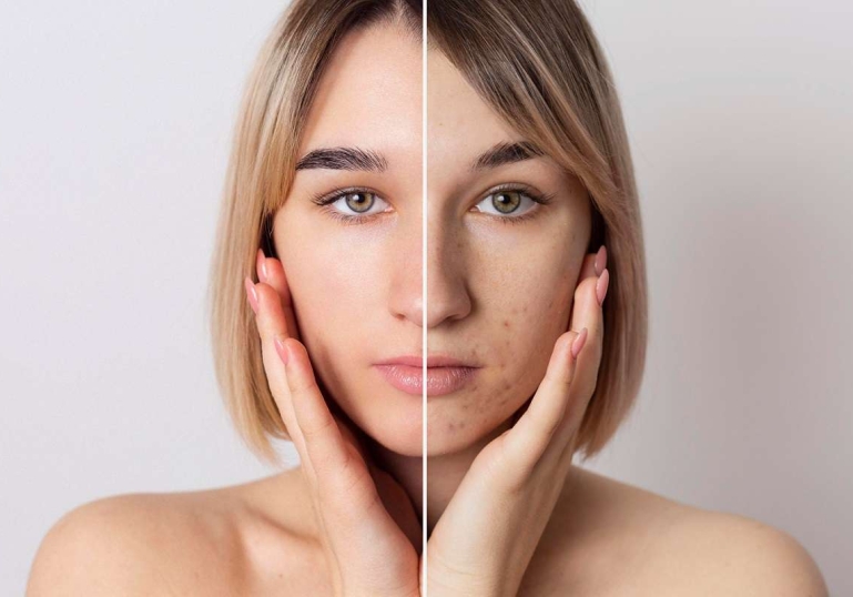 چگونه سوراخ های صورت را از بین ببریم