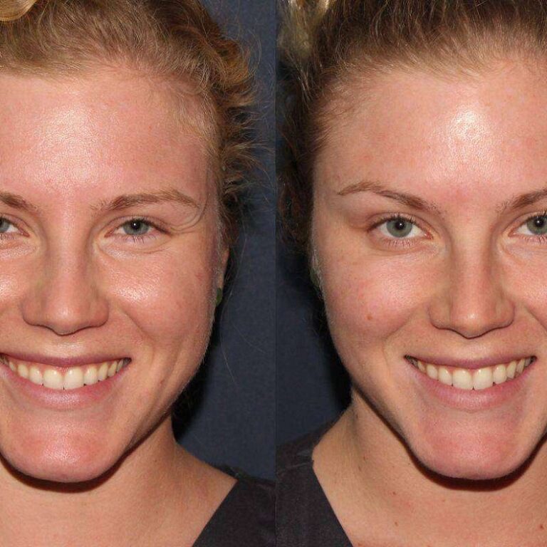 Photo before and after PRP around the eyes .