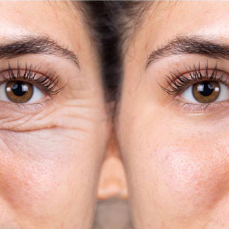 Photo before and after PRP around the eyes ...