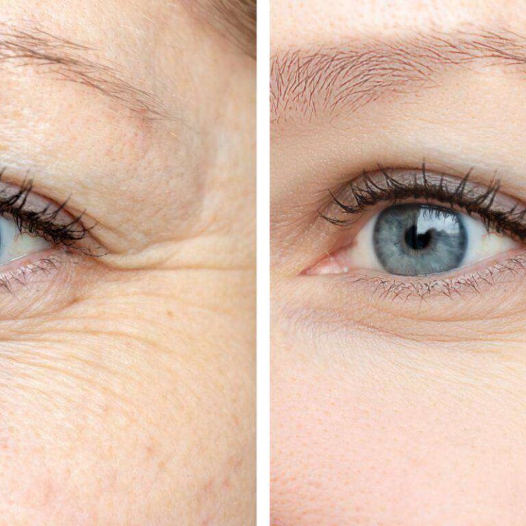 Photo before and after PRP around the eyes