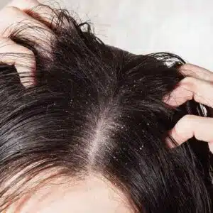 Photo of hair folliculitis ..