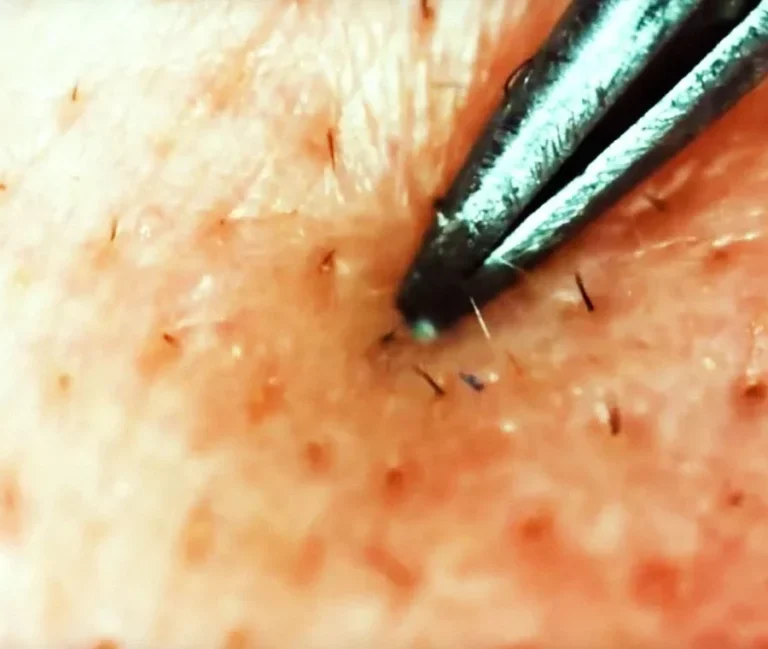 موهای زیر پوستی بعد از لیزر