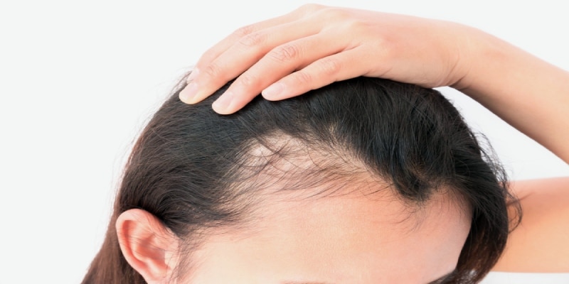 ریزش موی شدید زنان