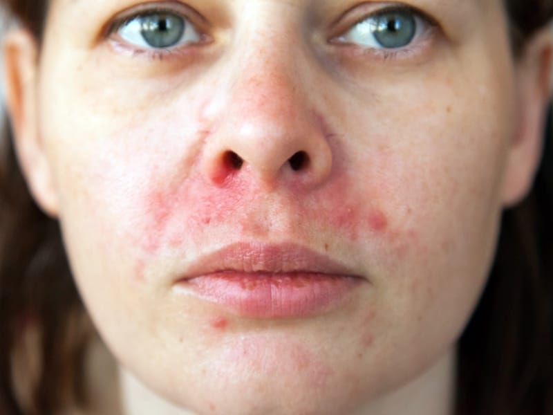 انواع پسوریازیس با عکس