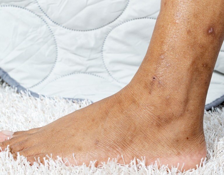 لکه های روی ساق پا