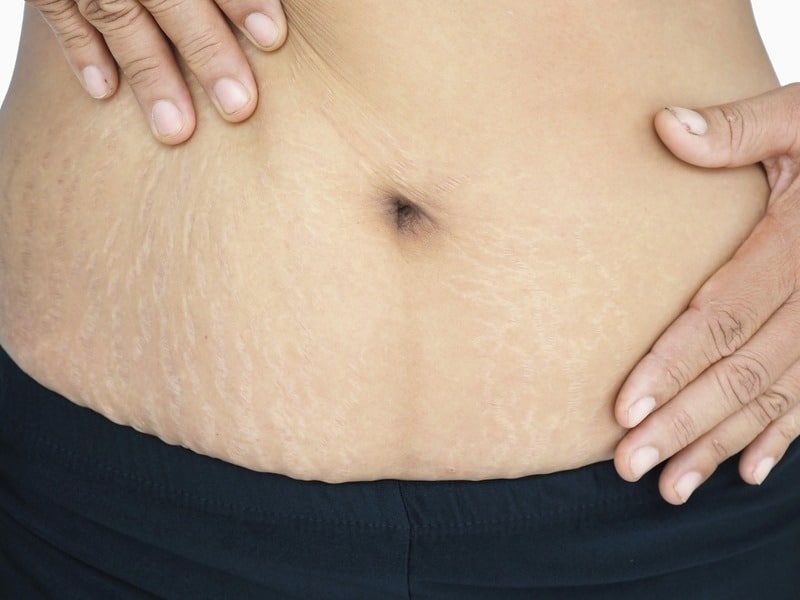 پیشگیری از ترک پوستی ناشی از چاقی