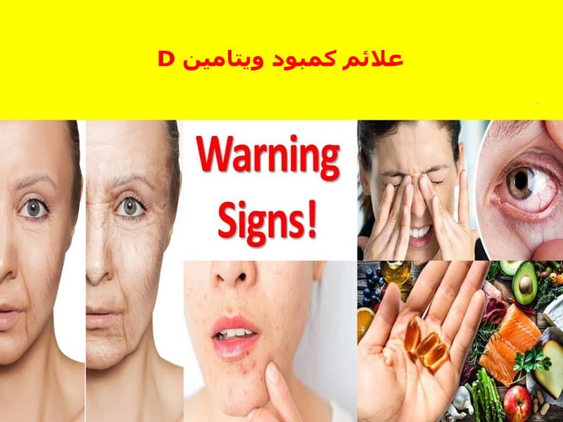 علائم کمبود ویتامین d
