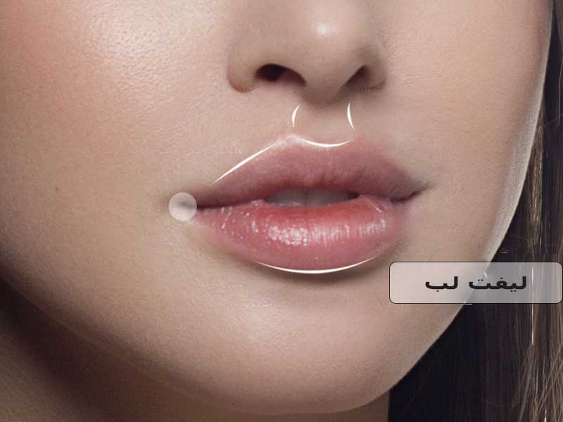 لیفت لب با ژل
