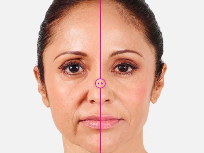 تاثیر تزریق فیلر خط خنده