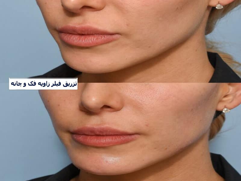 تزریق فیلر فک و چانه