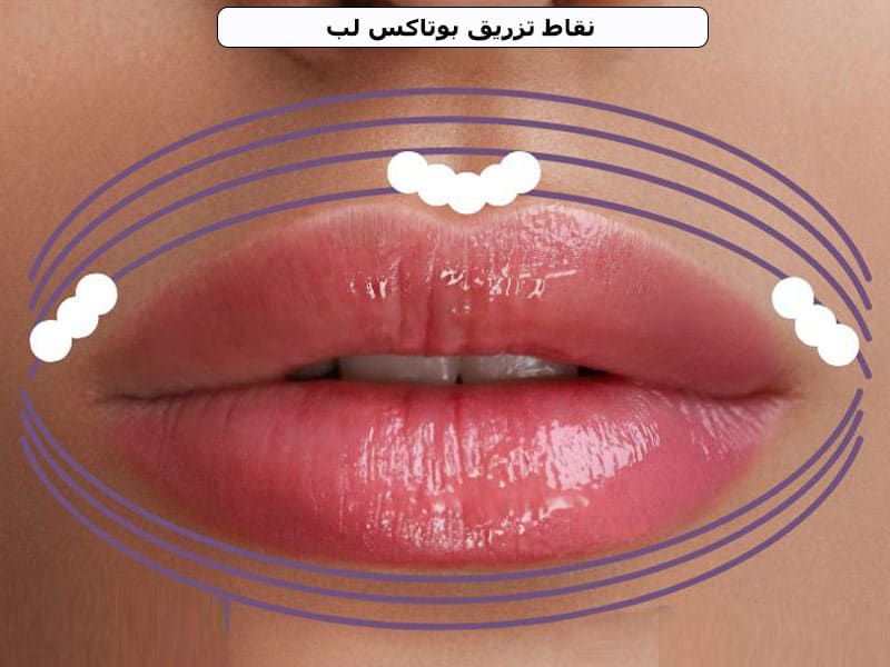 نقاط تزریق بوتاکس لب