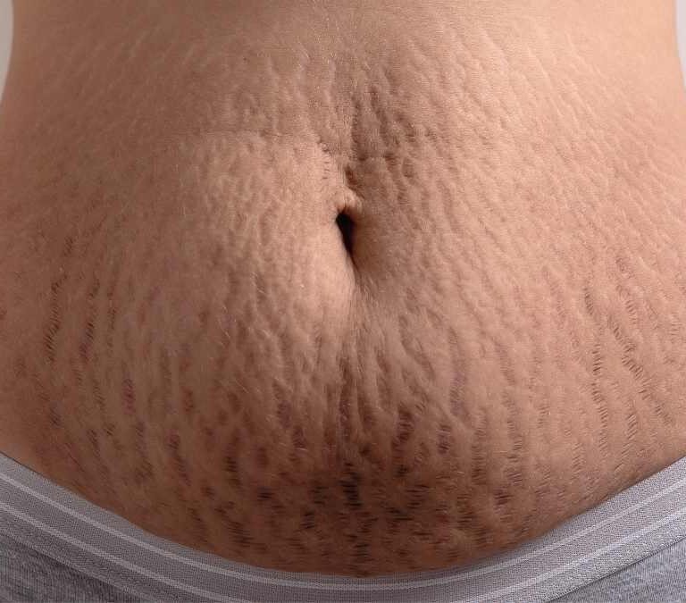 ترک پوستی چیست؟