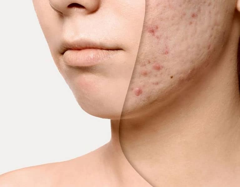 مراحل بهبود جای زخم جوش