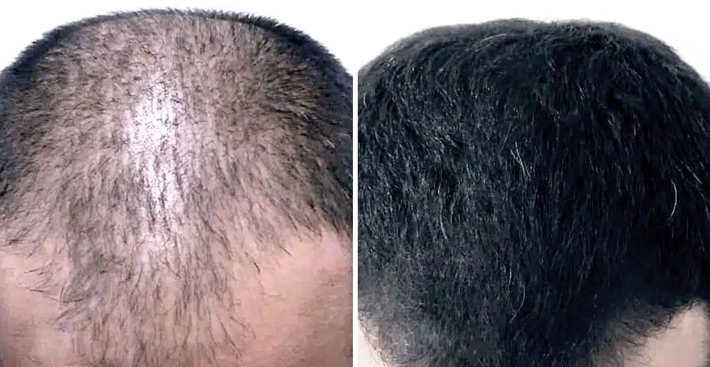 مزوتراپی مو تصاویر