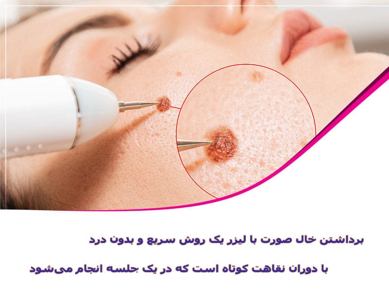 مزایای برداشتن خال صورت با لیزر