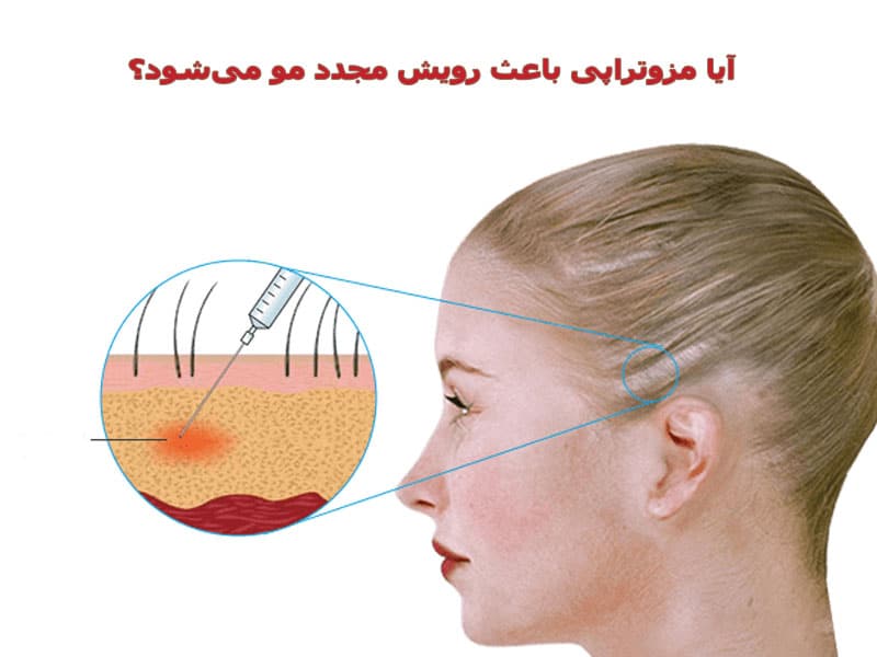 مزوتراپی باعث رویش مجدد مو میشود