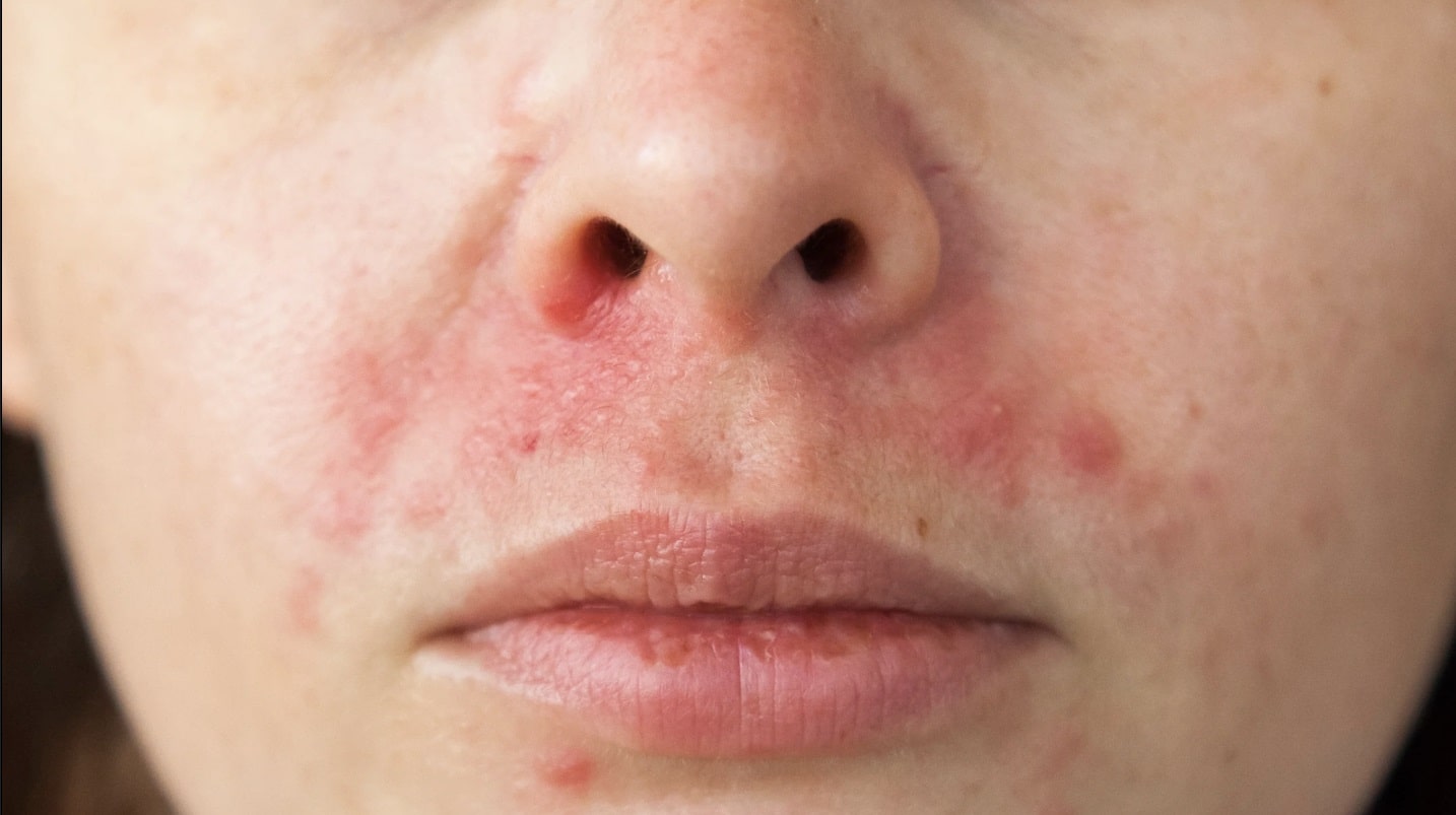 علایم درماتیت سبورئیک