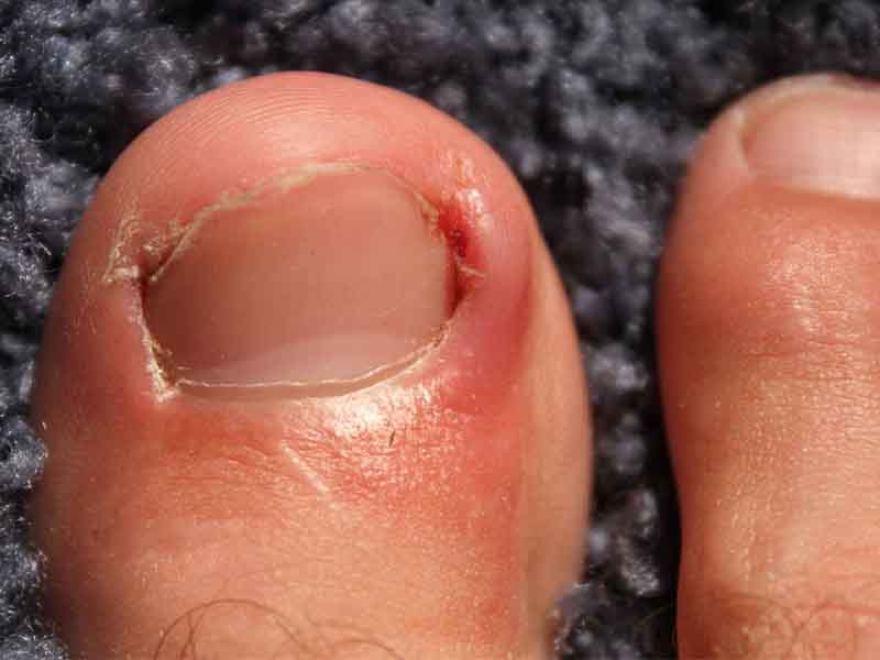 ناخن های در گوشت فرو رفته