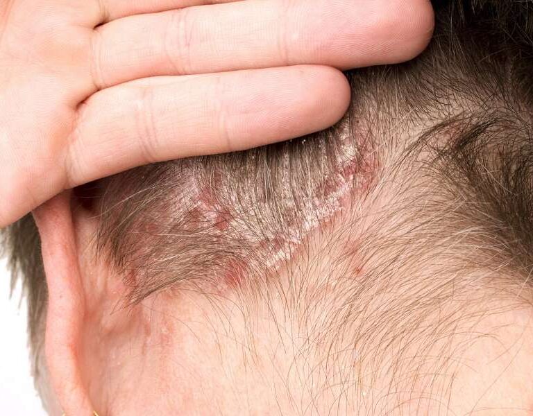 عوامل محرک درماتیت سبورئیک