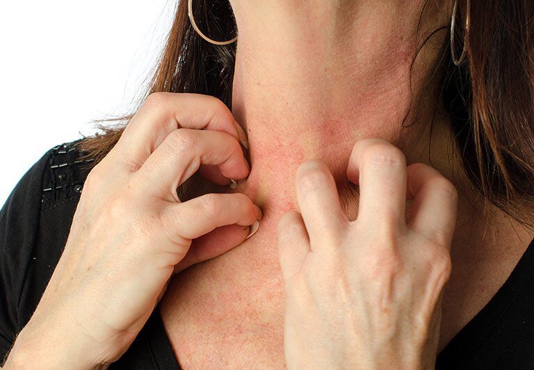 اگزمای عصبی