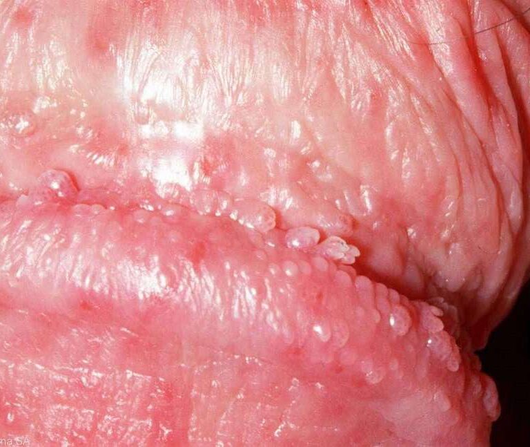 پاپول مرواریدی چقدر شایعه