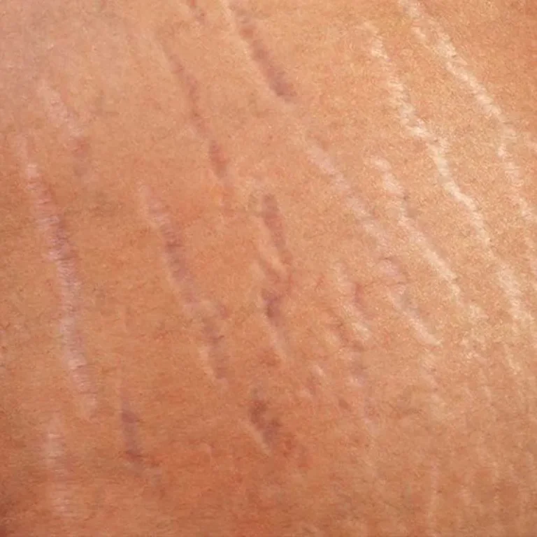ترک پوستی در کشاله ران
