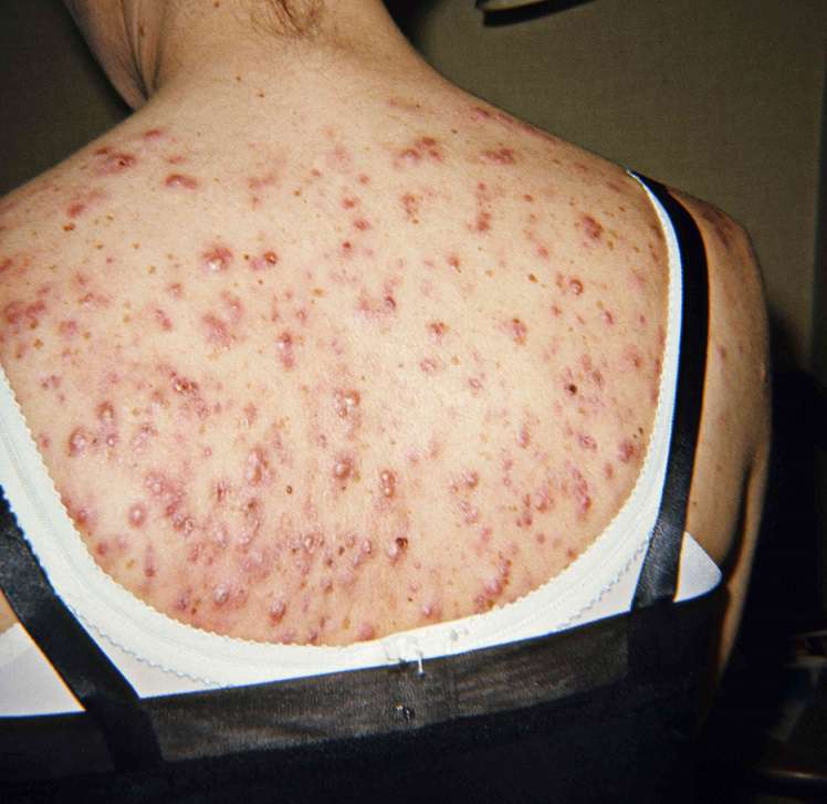 دانه های آبدار و خارش آن ها