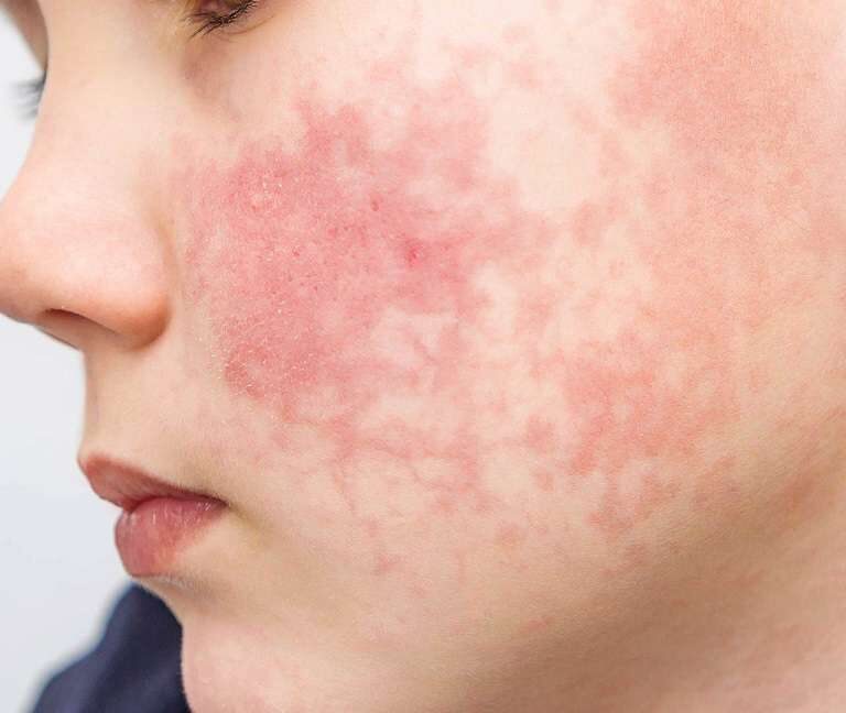 اریتما عفونی