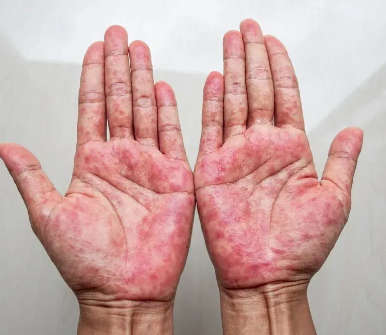 درماتیت تماسی تحریکی