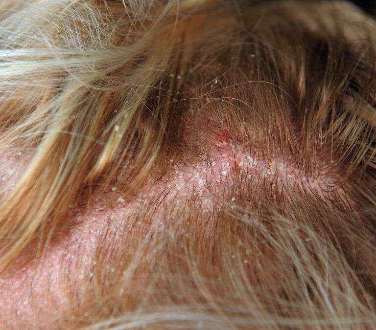 اختلال درماتیت سبورئیک