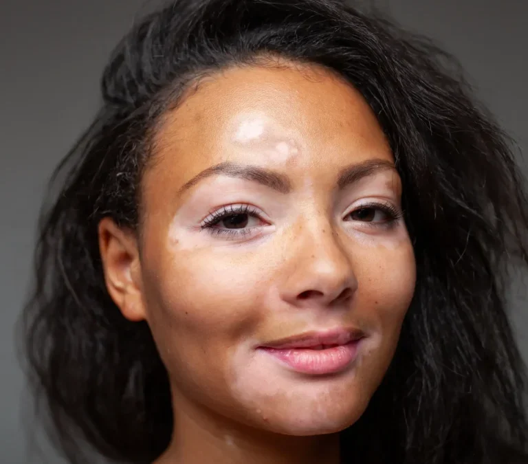 ویتیلیگو یا پیسی