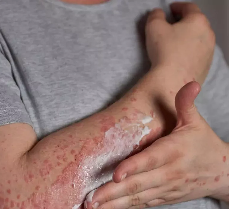 پماد برای لیکن پلان